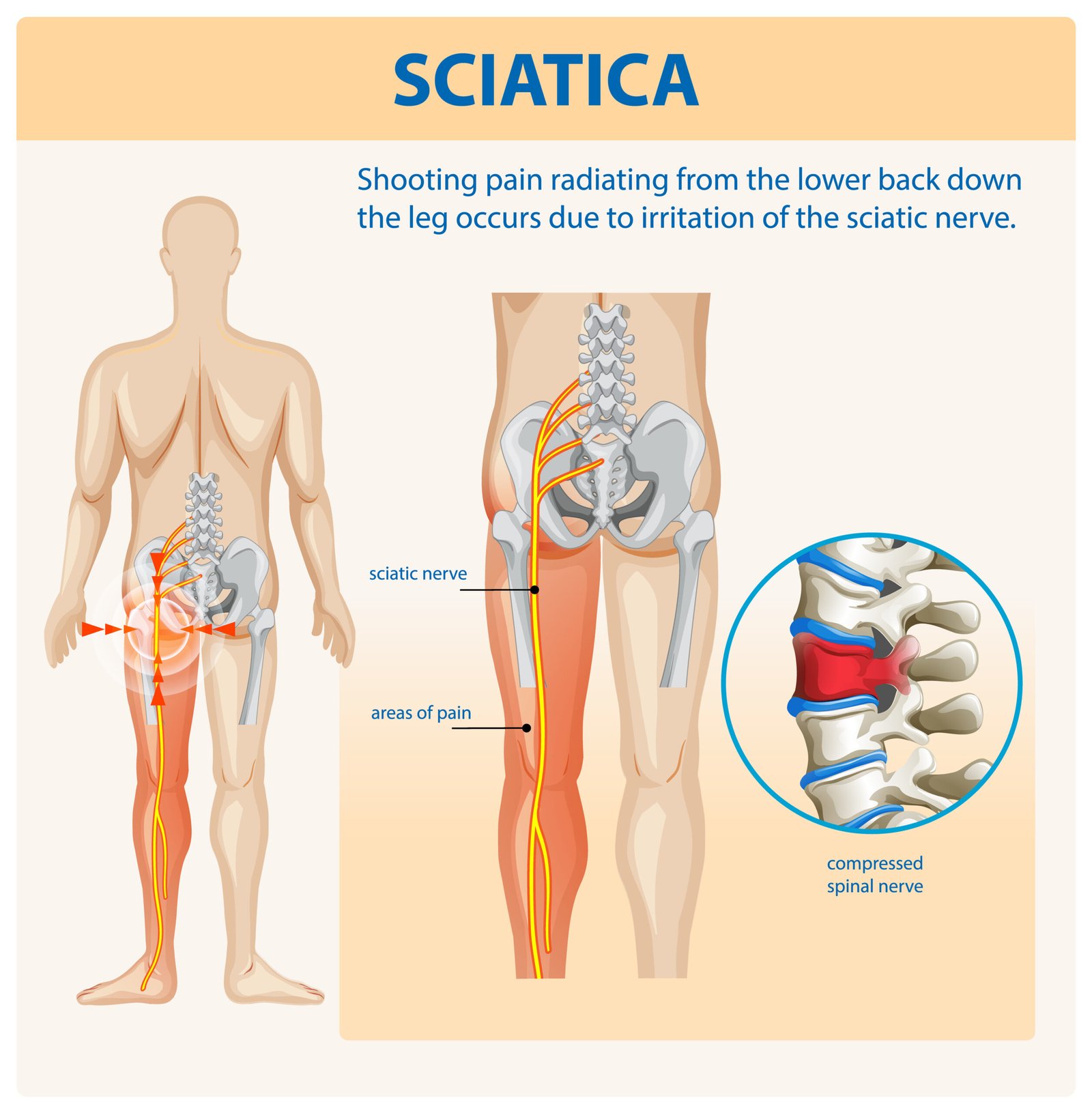Illustration of sciatica pain and nerve compression
