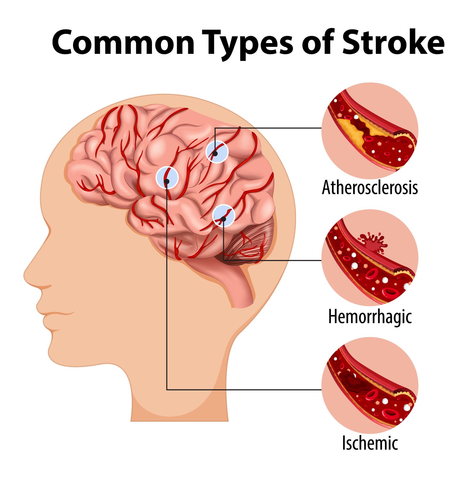 Human with common types of stroke illustration