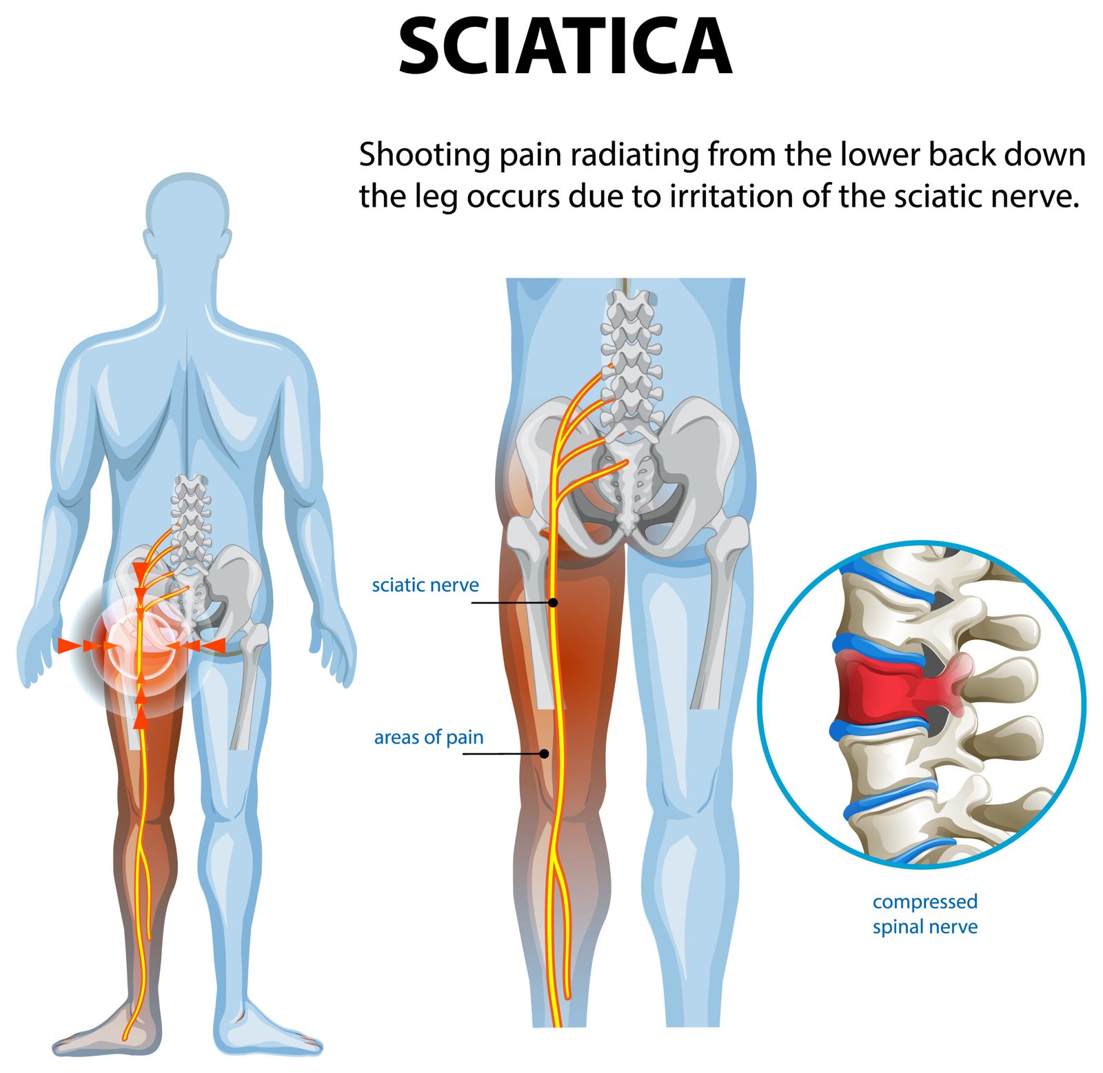 Illustration of sciatica pain and affected areas
